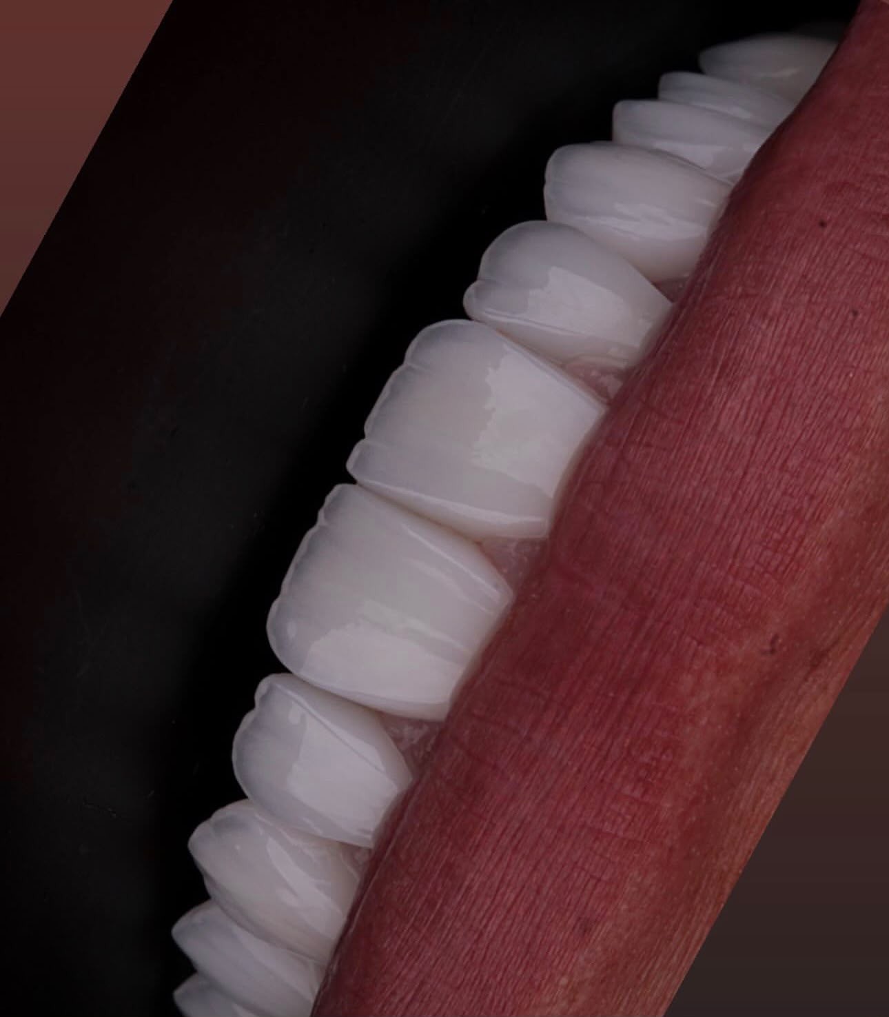 Sorriso com lentes de contato dental feitas na TM Odontologia